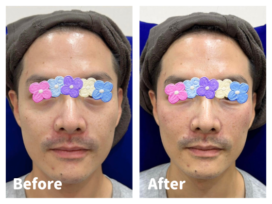 黑眼圈治療前後對比大圖