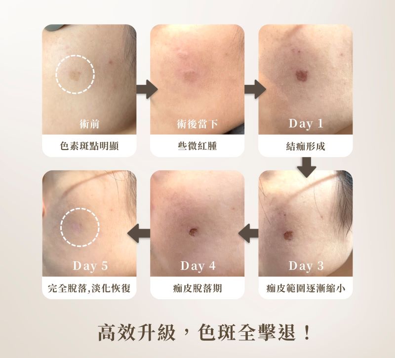 755皮秒雷射術後恢復過程