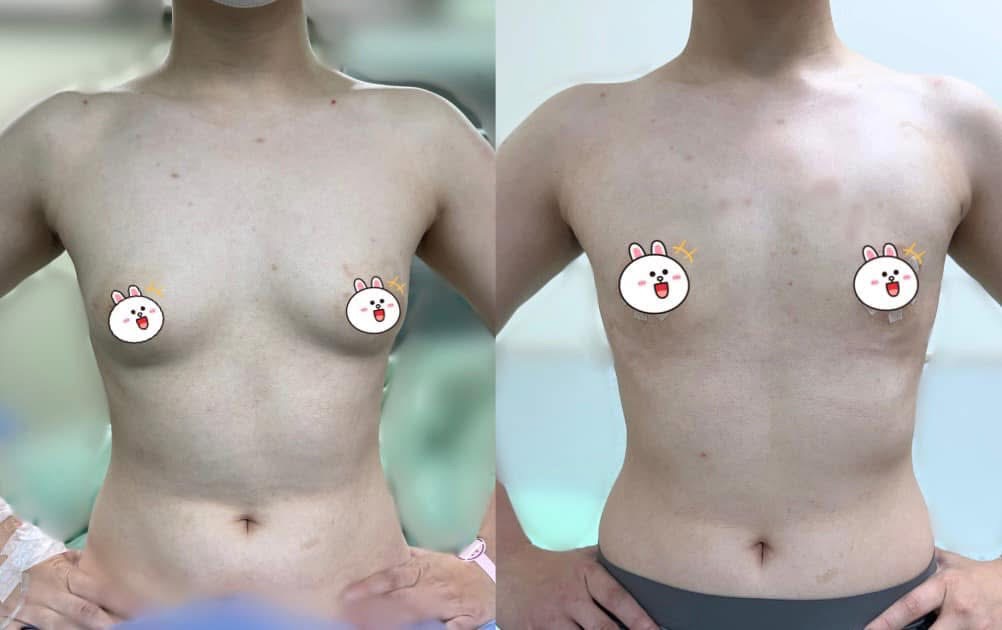 平胸手術術前術後照