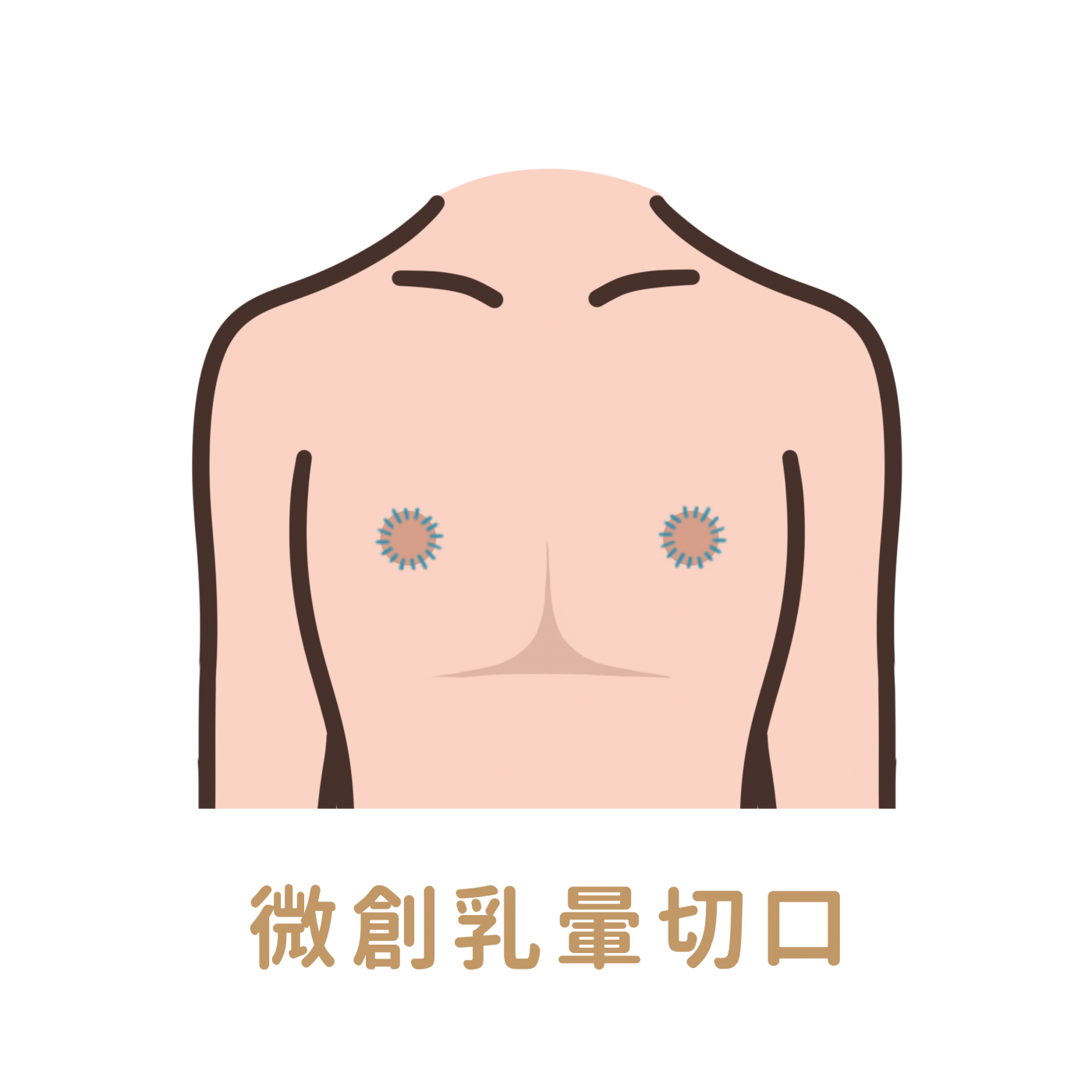 平胸手術乳暈周圍切口示意圖