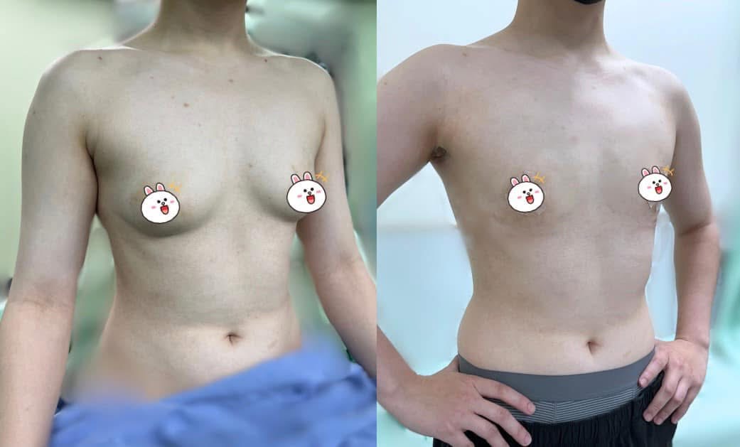 平胸手術術後恢復案例