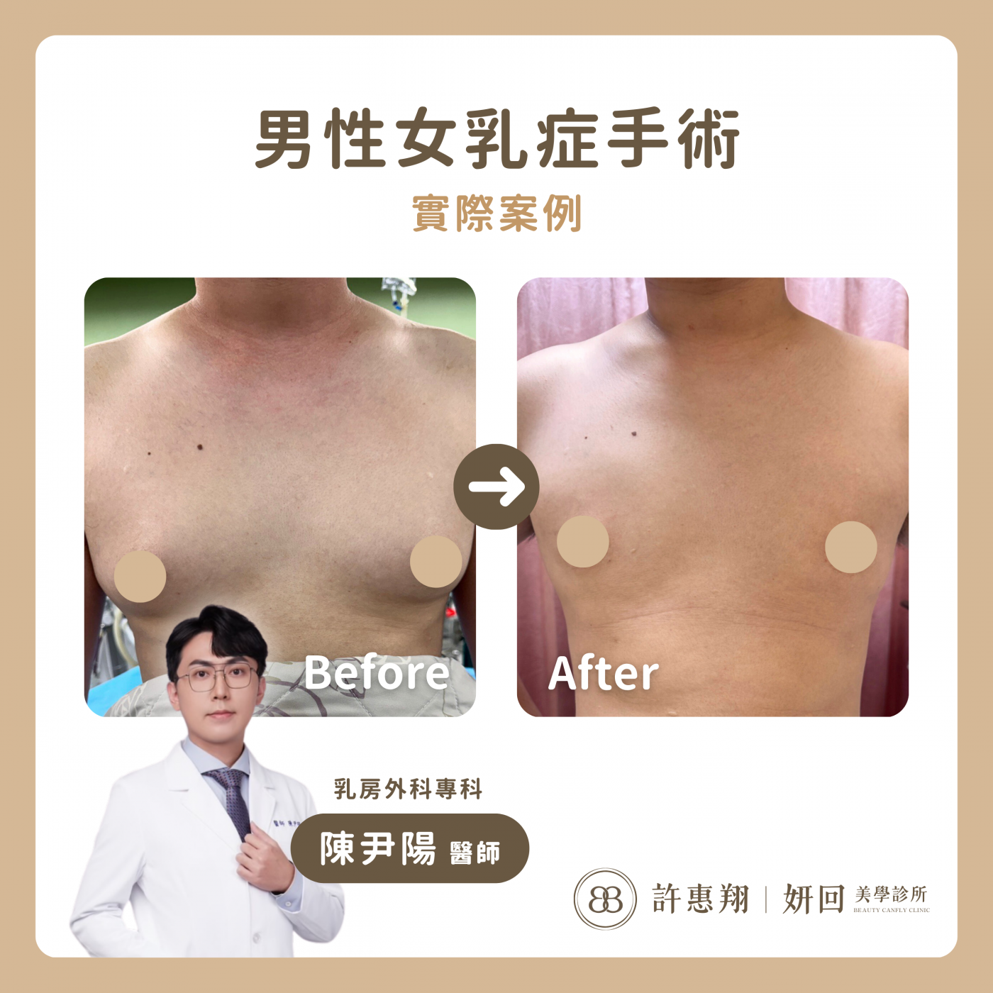 男性女乳症手術案例