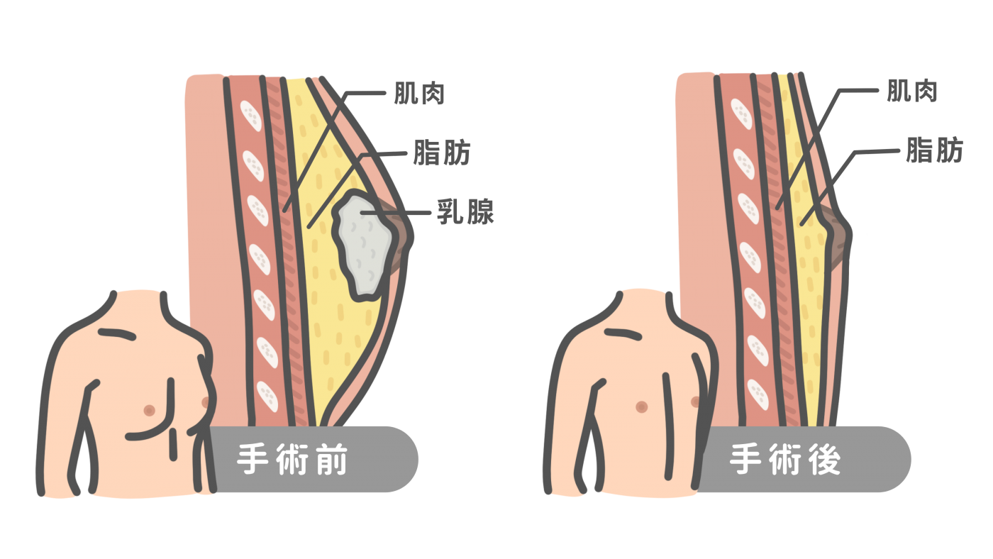 男性女乳症手術剖面圖