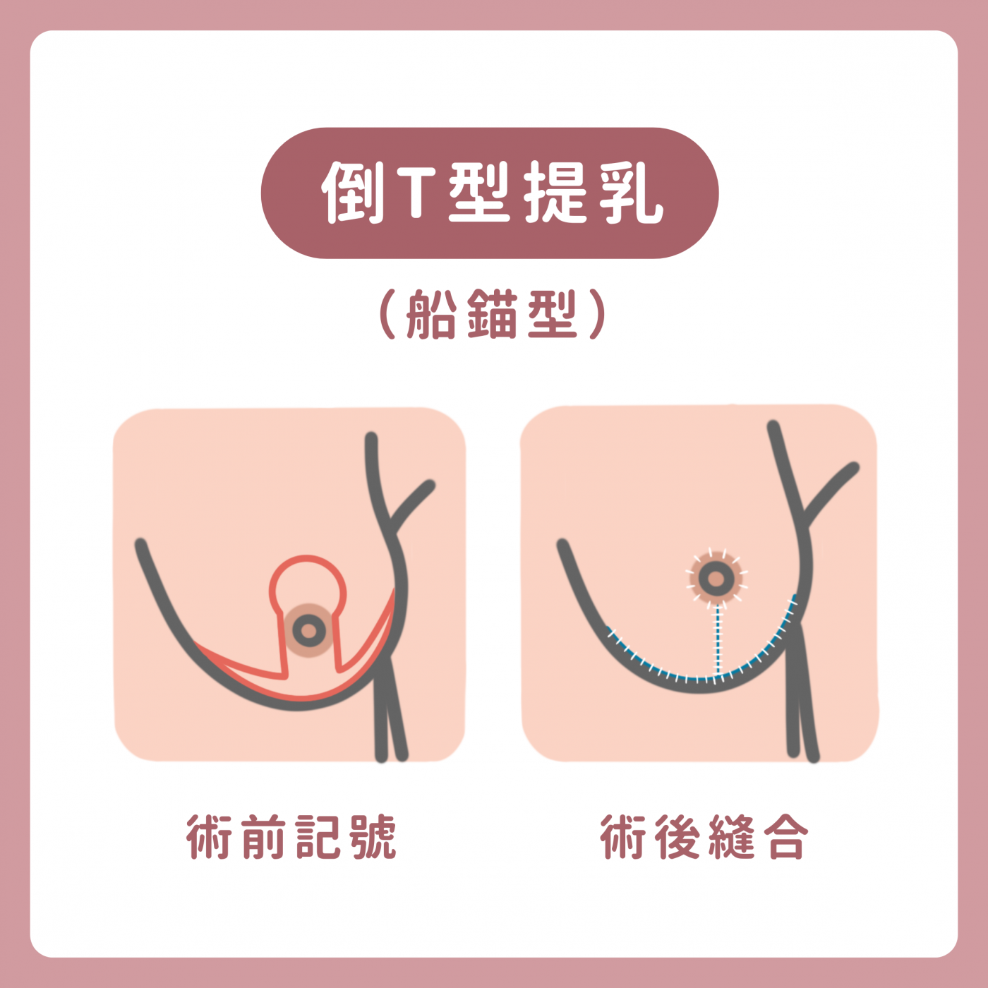 縮乳提乳案例解析
