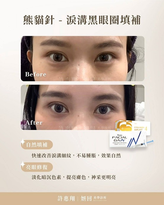 熊貓針前後對比