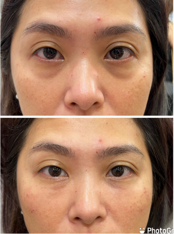 少女針填充蘋果肌案例