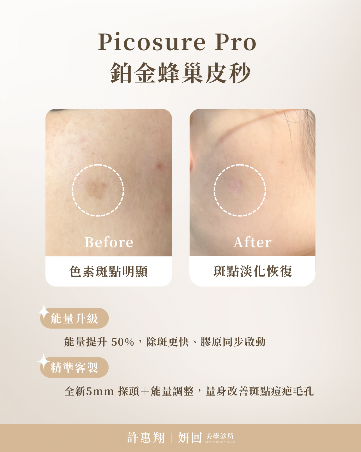 Picosure Pro 術前術後對比