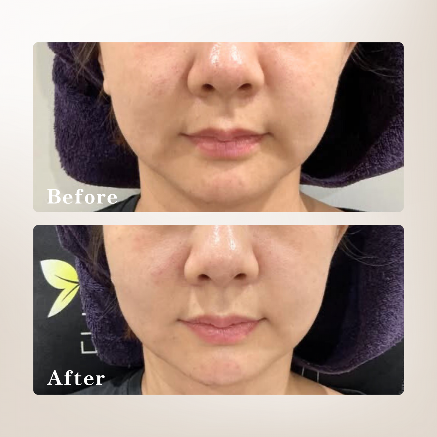 改善木偶紋治療示意圖-妍回美學診所