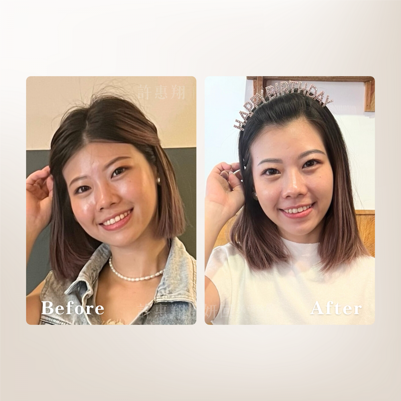 肉毒瘦小臉案例