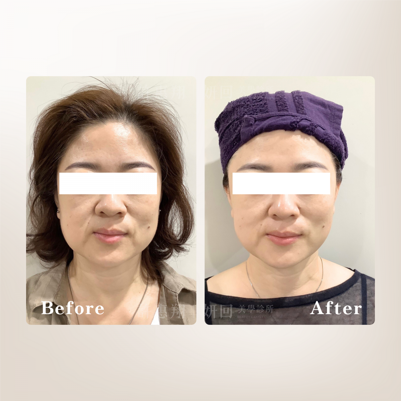 海芙音波小臉拉提示意1