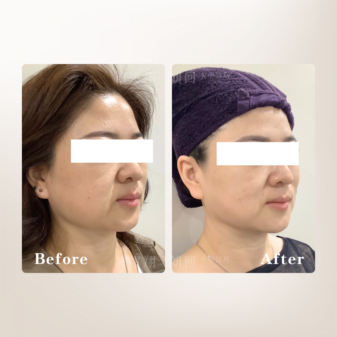 海芙音波小臉拉提示意2