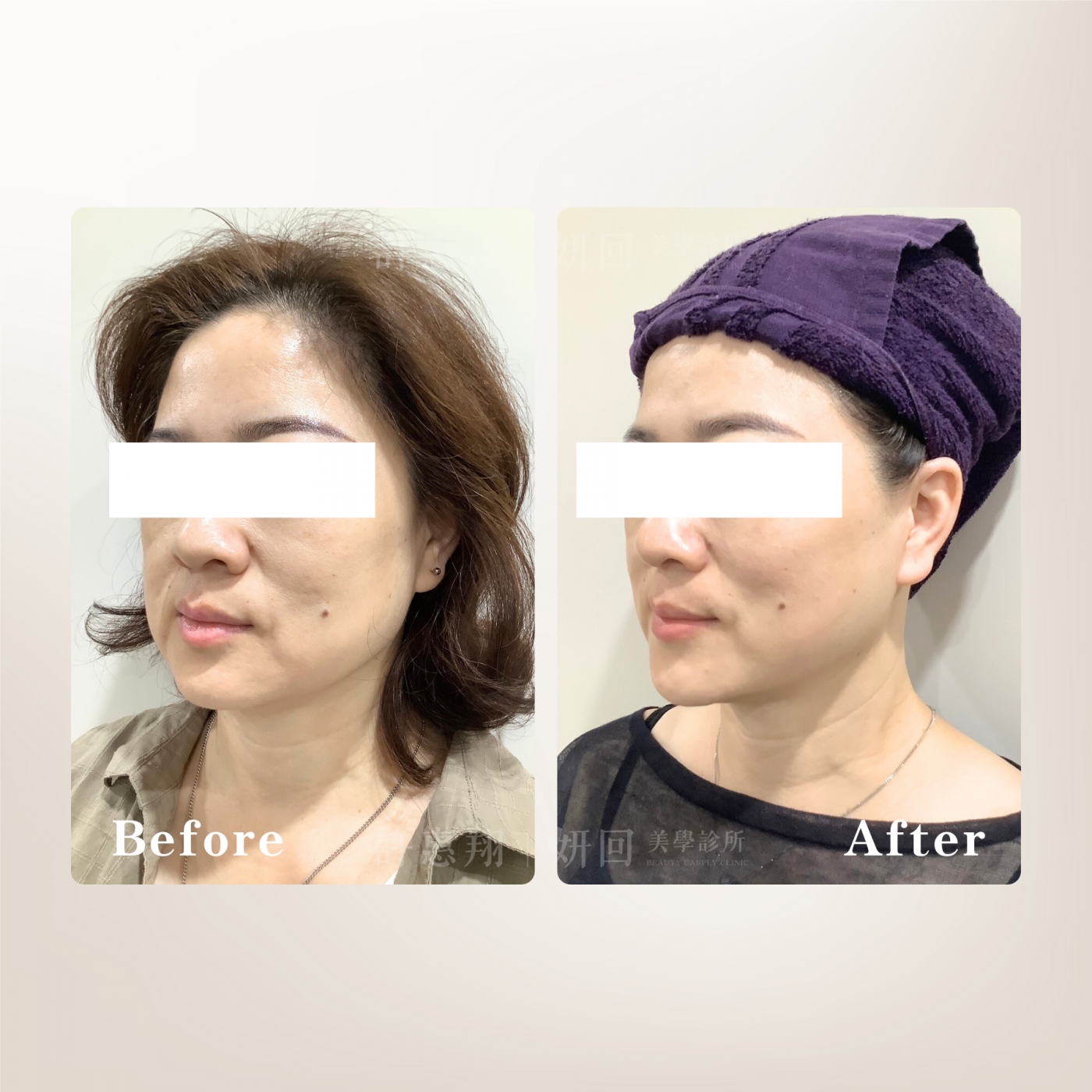 海芙音波小臉拉提示意3