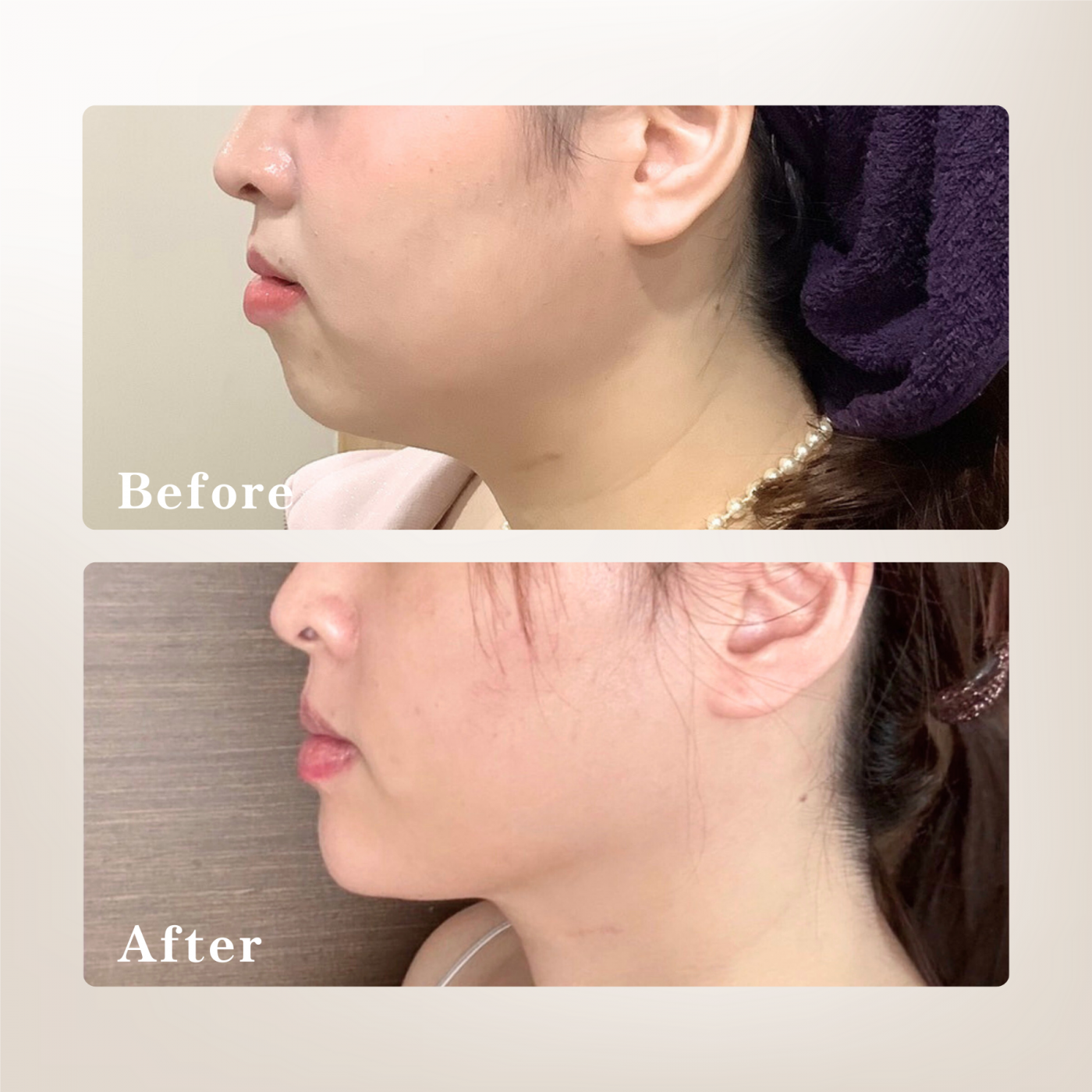 下顎線治療前後對比