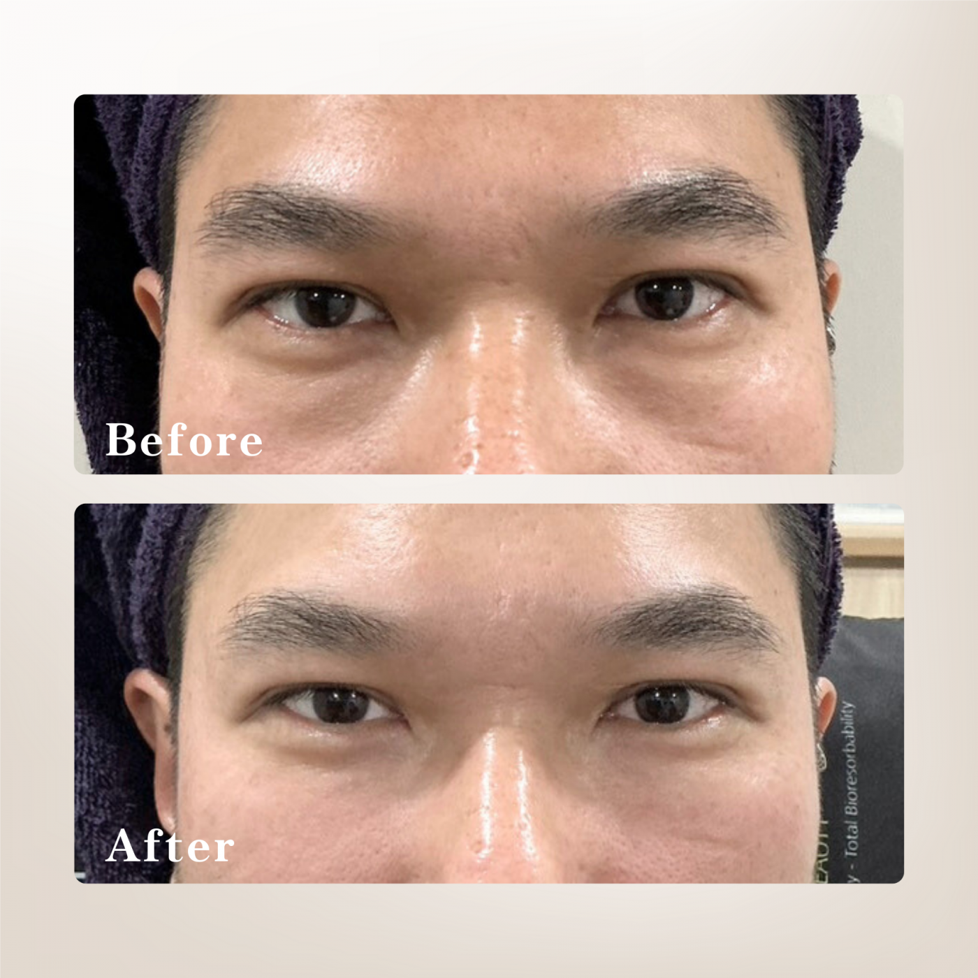 壯碩型男淚溝治療案例