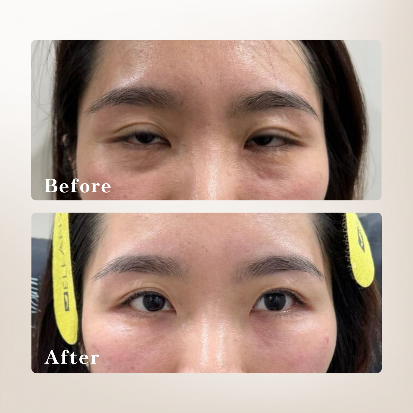 熊貓針術前術後改善案例