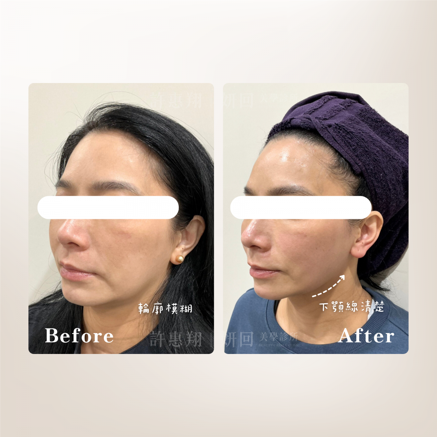 側面緊緻拉提案例