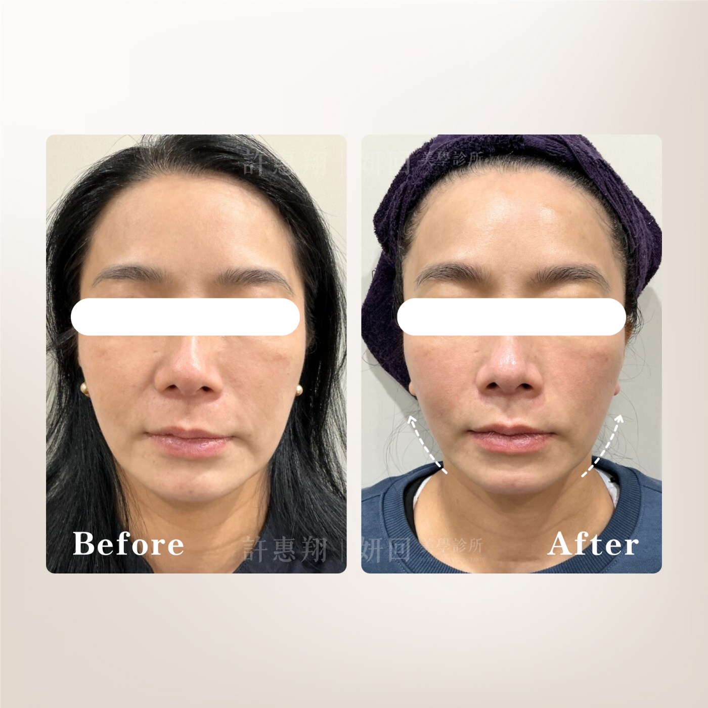 正面V臉重塑案例